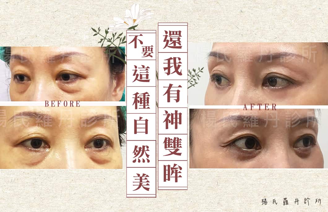 【眼袋淚溝】不要這種自然美！還我有神雙眸～